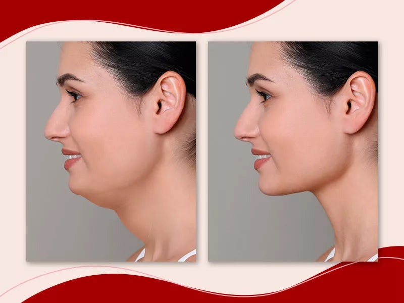 Máscara de Contorno Facial - Suaviza Rugas, Papada e Modela o Rosto