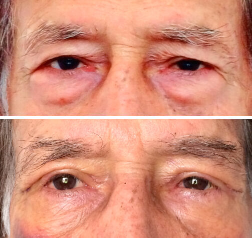 Remove Rugas 2 MINUTOS Instant FIRMx®