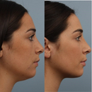 Máscara de Contorno Facial - Suaviza Rugas, Papada e Modela o Rosto