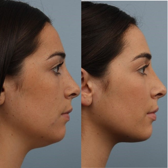 Máscara de Contorno Facial - Suaviza Rugas, Papada e Modela o Rosto