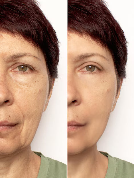 Remove Rugas 2 MINUTOS Instant FIRMx®